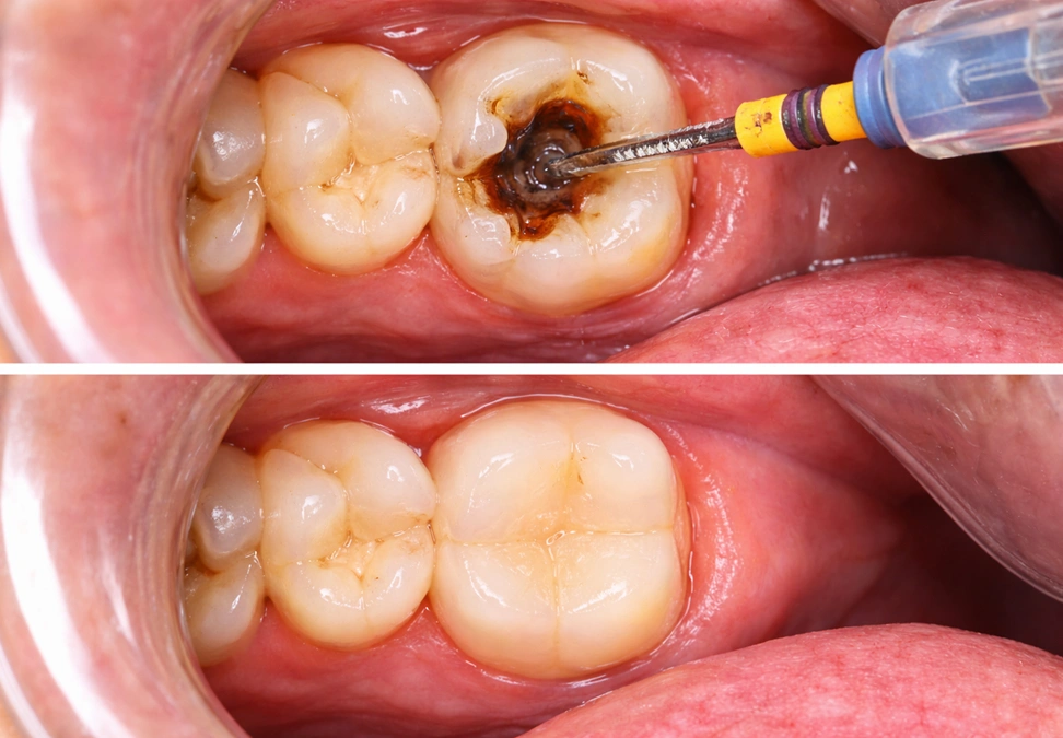 Before treatment