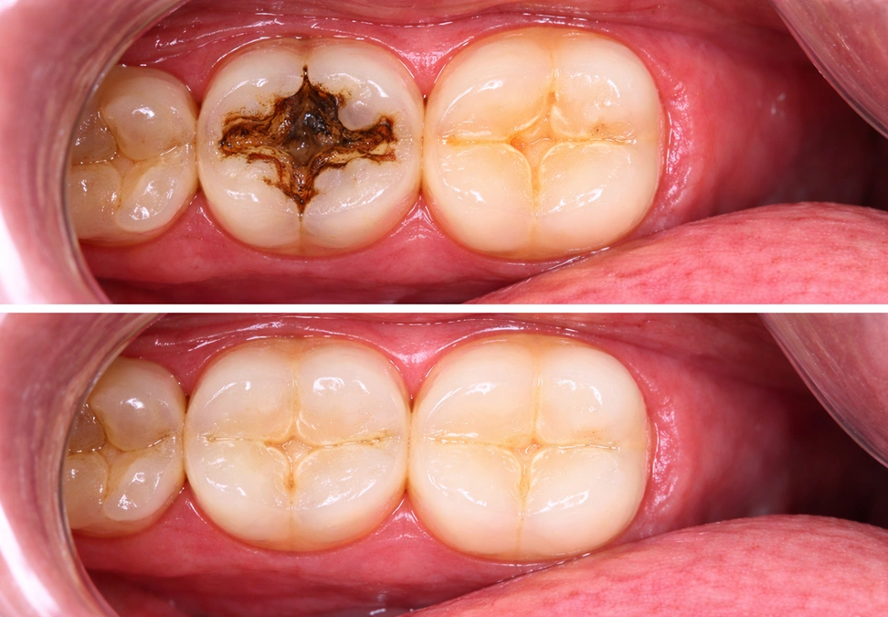 Before treatment