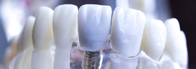 Dental Implant